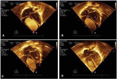 Case report: Accelerated regression of giant cardiac rhabdomyomas in neonates with low dose everolimus